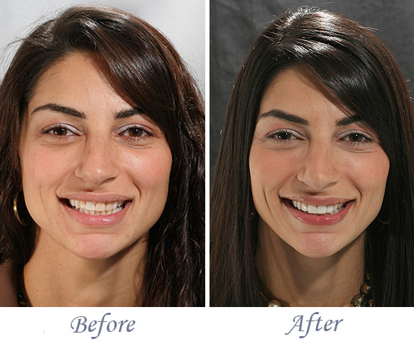 Porcelain Dental Teeth Veneers in Fresno, CA