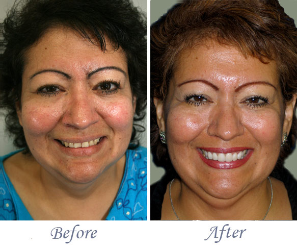 Smile Makeover in Fresno