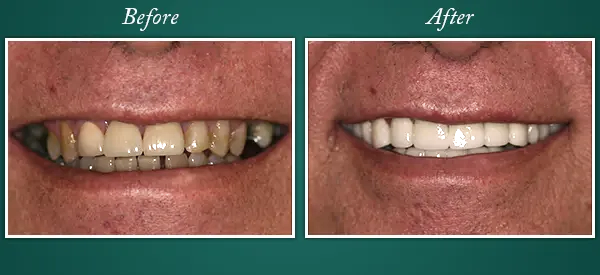 Before & After 1
