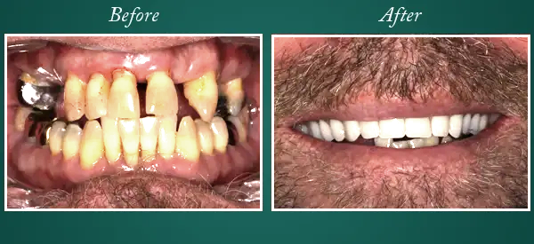 Before & After 13