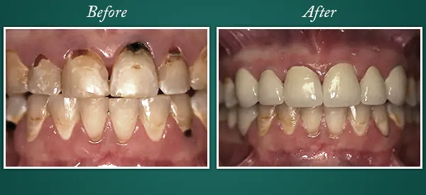 Before & After 2