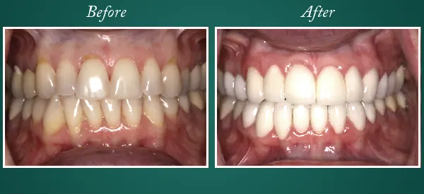 Before & After 24.2