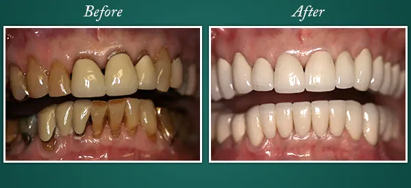 Before & After 5