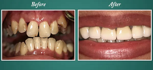 Before & After 6