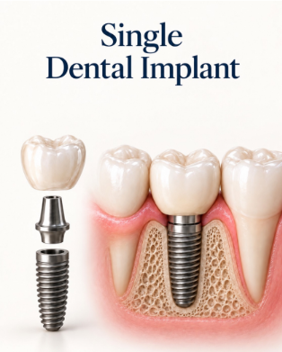 single-dental-implant