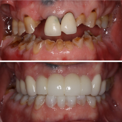 before-after-left