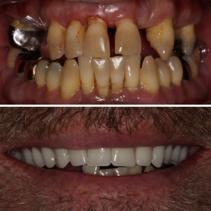 before-after-right