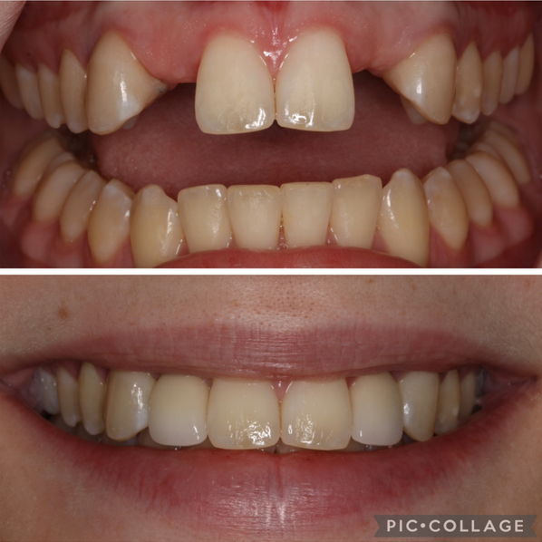dental_treatment_before-after